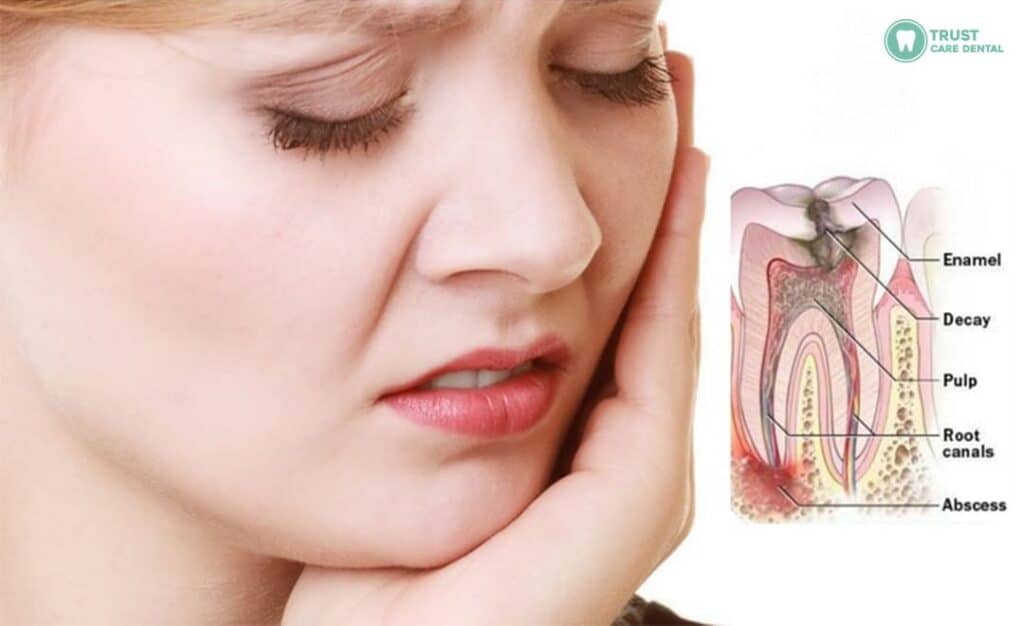 Common-Causes-of-Pain-After-a-Root-Canal