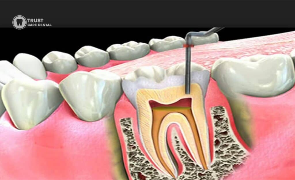 How-Long-Does-Pain-Last-After-a-Root-Canal