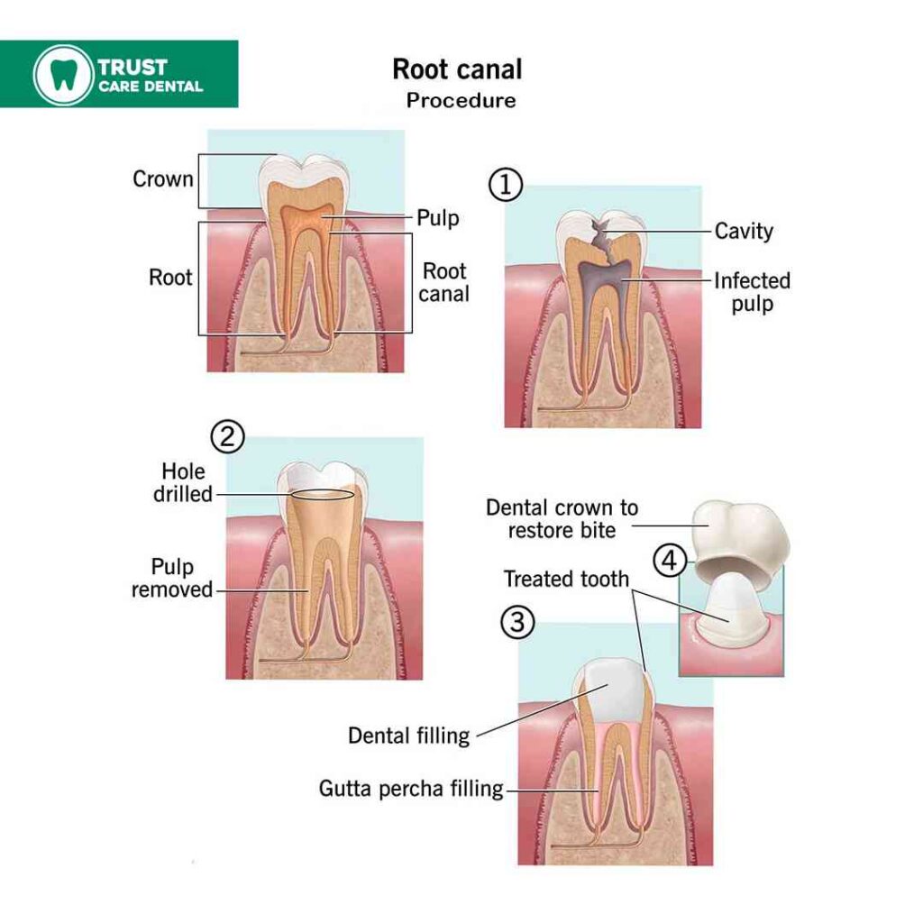 Root-Canal-Procedure