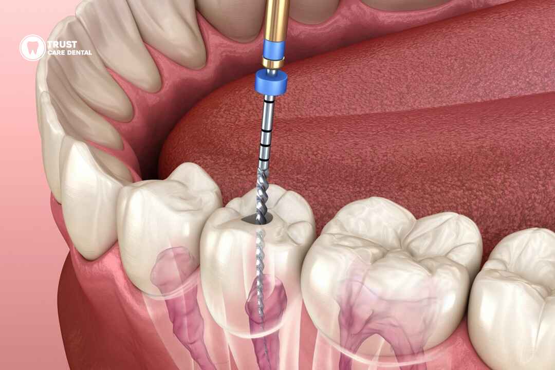 Root-Canal-Therapy